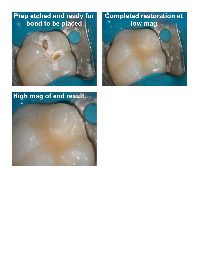 Microdental lower molar pg 3.jpg
